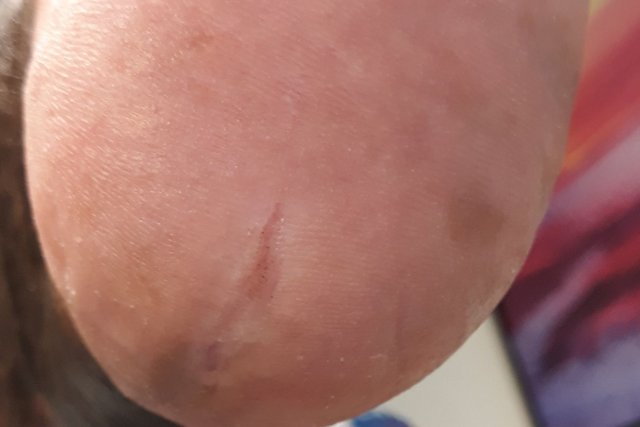 Dieselbe Ferse nach der Behandlung: glatte Haut, die Schrunden sind abgetragen